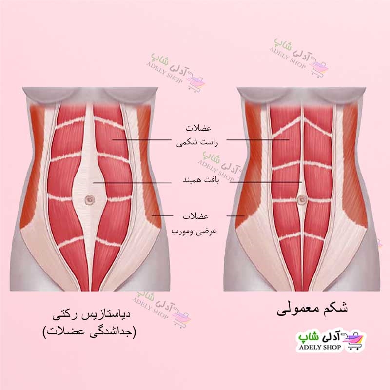 دیاستازیس رکتی چیست؟ راه پیشگیری و درمان